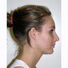 Rhinoplasty 9 After Photo Thumbnail