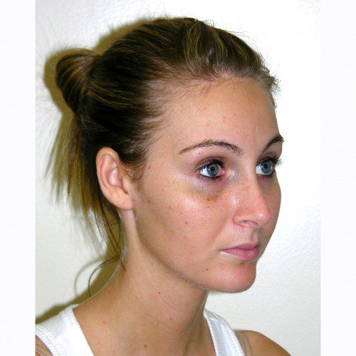 Rhinoplasty 9 After Photo