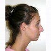 Rhinoplasty 9 Before Photo Thumbnail