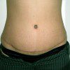 Abdominoplasty 14 After Photo Thumbnail