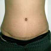 Abdominoplasty 14