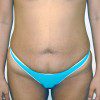 Abdominoplasty 14 Before Photo Thumbnail