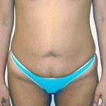 Abdominoplasty 14 Before Photo - 2