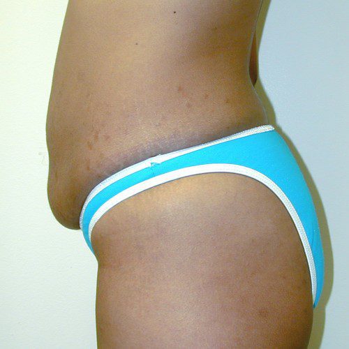 Abdominoplasty 14 Before Photo