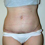 Abdominoplasty 15 After Photo - 2
