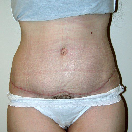 Abdominoplasty 15 After Photo 