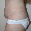 Abdominoplasty 15 After Photo Thumbnail