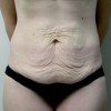 Abdominoplasty 15 Before Photo Thumbnail