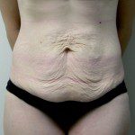 Abdominoplasty 15 Before Photo - 1