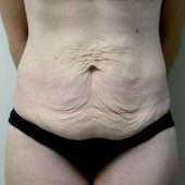 Abdominoplasty 15