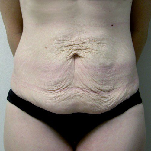 Abdominoplasty 15 Before Photo 