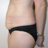 Abdominoplasty 15 Before Photo Thumbnail