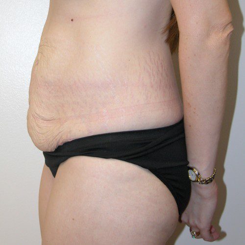 Abdominoplasty 15 Before Photo