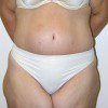 Abdominoplasty 16 After Photo Thumbnail