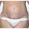 Abdominoplasty 16 After Photo Thumbnail