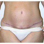 Abdominoplasty 16 After Photo - 12