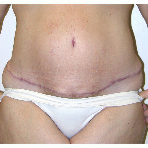 Abdominoplasty 16 After Photo 