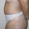 Abdominoplasty 16 After Photo Thumbnail