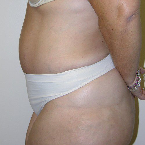 Abdominoplasty 16 After Photo