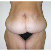 Abdominoplasty 16 Before Photo Thumbnail