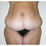 Abdominoplasty 16 Before Photo - 12