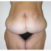 Abdominoplasty 16