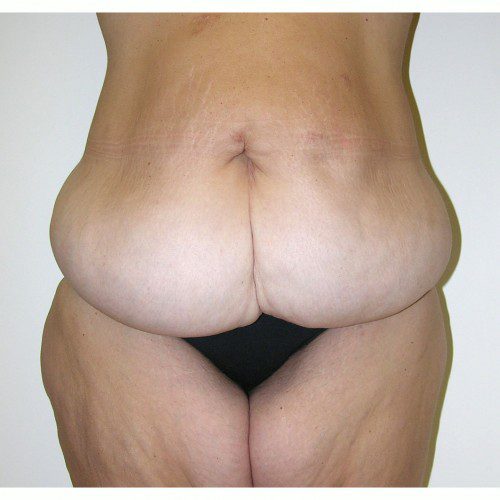 Abdominoplasty 16 Before Photo 