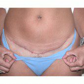 Mini-Abdominoplasty 13
