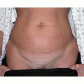 Mini-Abdominoplasty 13