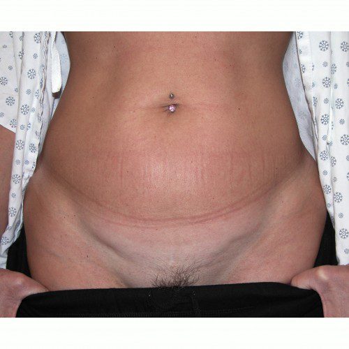 Mini-Abdominoplasty 13 Before Photo 