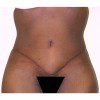 Abdominoplasty 17 After Photo Thumbnail