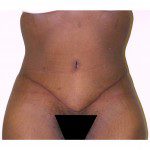 Abdominoplasty 17 After Photo - 12