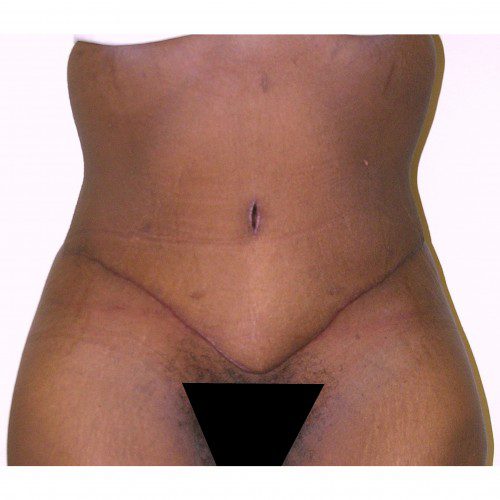 Abdominoplasty 17 After Photo 