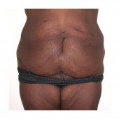 Abdominoplasty 17
