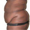 Abdominoplasty 17 Before Photo Thumbnail