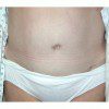 Abdominoplasty 18 After Photo Thumbnail