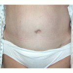 Abdominoplasty 18 After Photo - 10