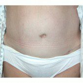 Abdominoplasty 18