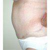 Abdominoplasty 18 After Photo Thumbnail