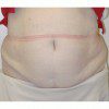 Abdominoplasty 18 Before Photo Thumbnail