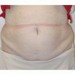 Abdominoplasty 18 Before Photo - 11