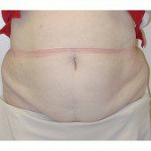 Abdominoplasty 18