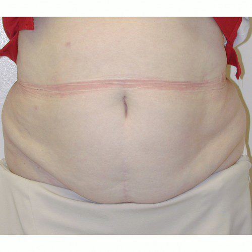 Abdominoplasty 18 Before Photo 