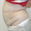 Abdominoplasty 18 Before Photo Thumbnail