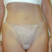 Abdominoplasty 6