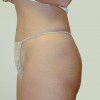 Abdominoplasty 6 After Photo Thumbnail