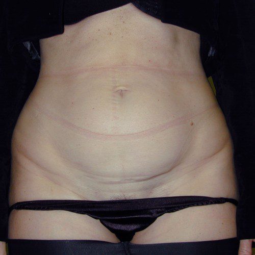 Abdominoplasty 6 Before Photo 