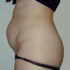 Abdominoplasty 6 Before Photo Thumbnail