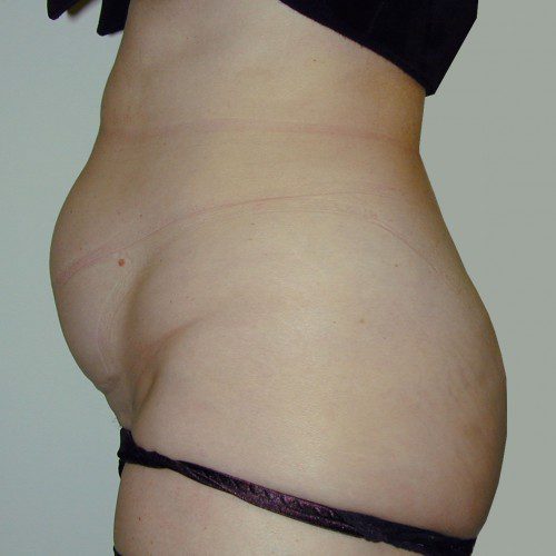 Abdominoplasty 6 Before Photo