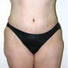 Abdominoplasty 19 After Photo Thumbnail